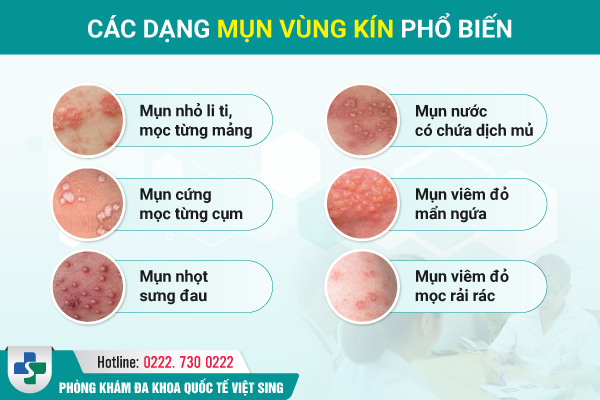 Nhận biết các loại mụn ở vùng kín – Chẩn đoán chính xác bệnh lý