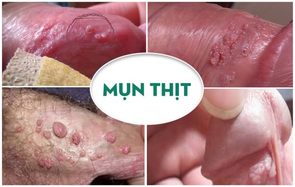 Nổi mụn thịt vùng kín nam nữ: Một biểu hiện, nhiều nguyên nhân
