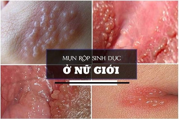 https://benhxahoibacninh.vn/wp-content/uploads/2025/08/mun-rop-sinh-duc-nu-1.jpg