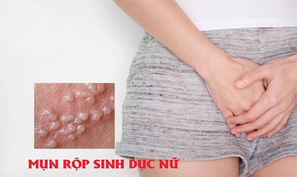 https://benhxahoibacninh.vn/wp-content/uploads/2025/08/mun-rop-sinh-duc-nu.jpg
